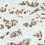 Microscopic image showing clusters of dark-stained cell nuclei within a fibrous, light-stained tissue background.