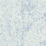 Microscopic view of tissue sample showing numerous light blue cells and scattered dark brown-stained nuclei, indicating areas of possible immunohistochemical staining.