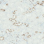 Microscopic image showing tissue with numerous dark brown-stained cell nuclei scattered throughout a lighter background, indicating areas of cellular activity or marker expression.