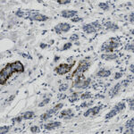 Microscopic image showing clusters of blue-stained cells with irregular shapes and scattered brown-stained structures within a tissue sample.