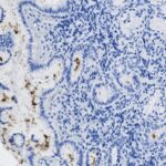 Microscopic image of tissue section stained blue and brown, showing dense clusters of cells with varying shapes and scattered darker regions.