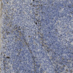 Microscopic image of tissue stained with hematoxylin and DAB, showing densely packed blue and brown-stained cells with some fibrous structures on the left side.