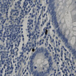 Microscopic view of tissue stained with hematoxylin and eosin, showing densely packed blue-stained nuclei and several larger, irregularly shaped cells.