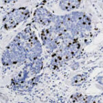 Microscopic image of tissue sample showing clusters of cells with darkly stained nuclei scattered throughout a lighter background.