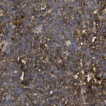 Microscopic view of densely packed cells stained brown and blue, showing a granular texture across the image.