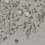 Microscopic view of tissue showing numerous dark-stained cells scattered within a fibrous matrix, possibly from a histological or pathology slide.