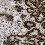 Microscopic view of tissue sample stained with dark brown and light areas, showing cellular and structural patterns.