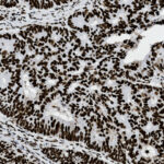 Microscopic view of tissue sample showing densely packed dark-stained cell nuclei and lighter background, commonly seen in histological or pathological analysis.
