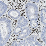 Microscopic image showing glandular tissue cells stained blue and surrounded by numerous small dark brown nuclei.