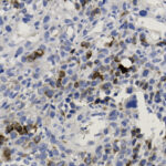 Microscopic view of stained tissue showing densely packed cells, some with dark brown staining, indicating positive immunohistochemical reaction among mostly blue-stained cells.