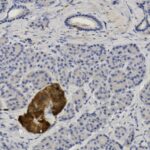 Microscopic view of tissue with densely packed blue-stained cells and a distinct brown-stained area in the lower center, indicating possible abnormality or staining reaction.