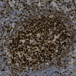 Microscopic image showing densely packed dark brown cells within a lighter background, likely representing stained tissue in a biological sample.