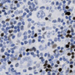 Microscopic view of cells stained with varying intensities, showing clusters of dark brown and light blue cell nuclei against a white background.