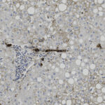 Microscopic image of liver tissue showing clusters of blue-stained cell nuclei, clear fat vacuoles, and scattered brown-stained structures.