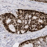 Microscopic image of tissue stained to highlight cell nuclei, showing densely packed dark brown nuclei within glandular structures against a lighter background.