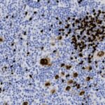 Microscopic view of tissue stained blue and brown, showing densely packed cells with clusters of dark brown-stained areas among lighter blue cells.