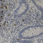 Microscope image shows tissue section with blue-stained nuclei and scattered brown-stained cells, indicating immunohistochemical staining in a histology specimen.