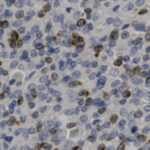Microscopic image of cells stained with blue and brown dyes, showing various round cell nuclei clustered densely across the field.