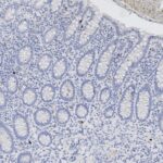 Microscopic image of tissue section showing glandular structures and densely packed cells, likely from a histological sample stained to highlight cellular and structural details.