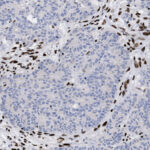 Microscopic view of tissue sample showing clusters of dark-stained cells scattered among lighter-stained cells, indicating possible cellular differentiation or marker expression.