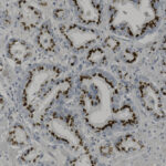Microscopic image showing tissue with brown-stained cell membranes, indicating positive immunohistochemical staining, surrounded by unstained and lightly stained areas.