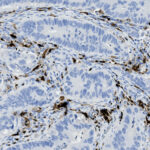 Microscopic view of tissue stained with hematoxylin and DAB, showing cells with varying morphology and areas of brown immunoreactive staining.