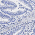 Microscopic image of tissue sample showing glandular structures and numerous blue-stained cell nuclei, likely from a histological or pathology slide.