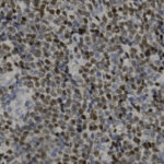 Microscopic view of stained tissue showing numerous small, round cells with dark brown and blue nuclei, possibly indicative of immunohistochemistry analysis.