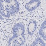 Histology slide showing stained tissue with round and oval cell structures, likely glandular, and numerous dark-stained nuclei dispersed throughout.