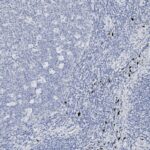 Microscopic image of tissue sample showing densely packed cells with some lighter and darker regions, possibly indicating staining differences or varied cell types.