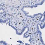 Microscopic view of tissue sample stained blue, showing clustered cells with irregular, finger-like projections and scattered dark spots.
