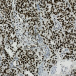 Microscopic image showing densely packed cells with dark-stained nuclei, typical of a tissue sample stained for histological examination.