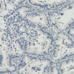 Microscopic view of tissue sample stained in shades of blue, showing clustered cells with irregular shapes and clear spaces in between.