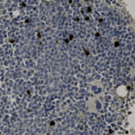 Microscopic image of tissue stained with hematoxylin and DAB, showing numerous blue-stained cells and scattered brown-stained nuclei.