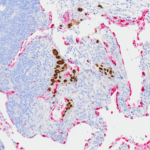 Tissue-Tek Genie® DUO anti-p40 / Napsin A Antibody Cocktail - Additional Image 3